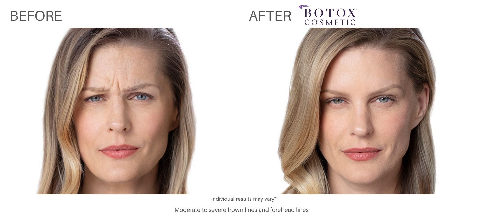 botox cosmetics treatment with Dr. Saimovici