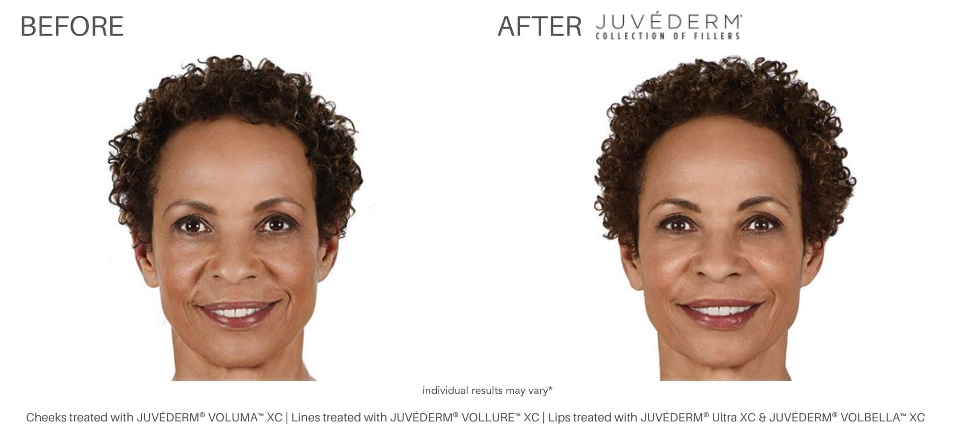 Juvéderm fillers treatment in Purchase, NY