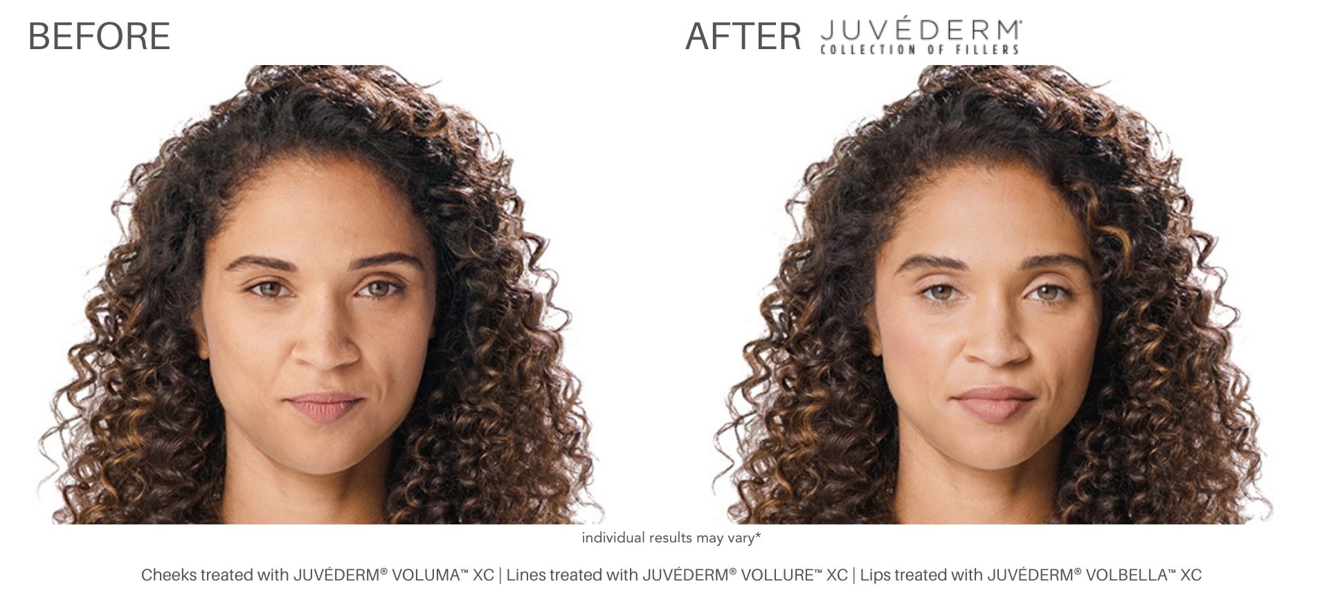 Juvéderm before and after pictures