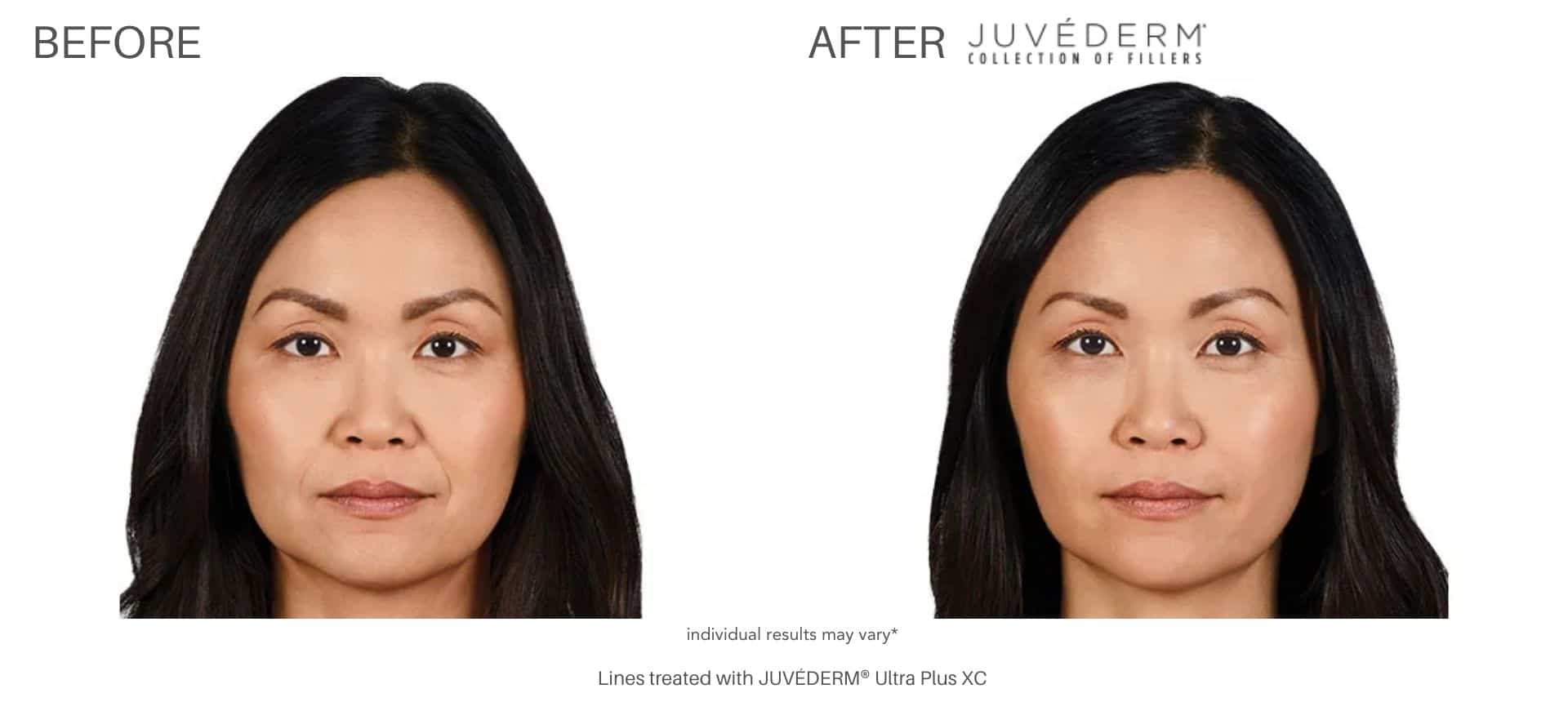 Facial fillers at Advanced Rejuvenation Centers