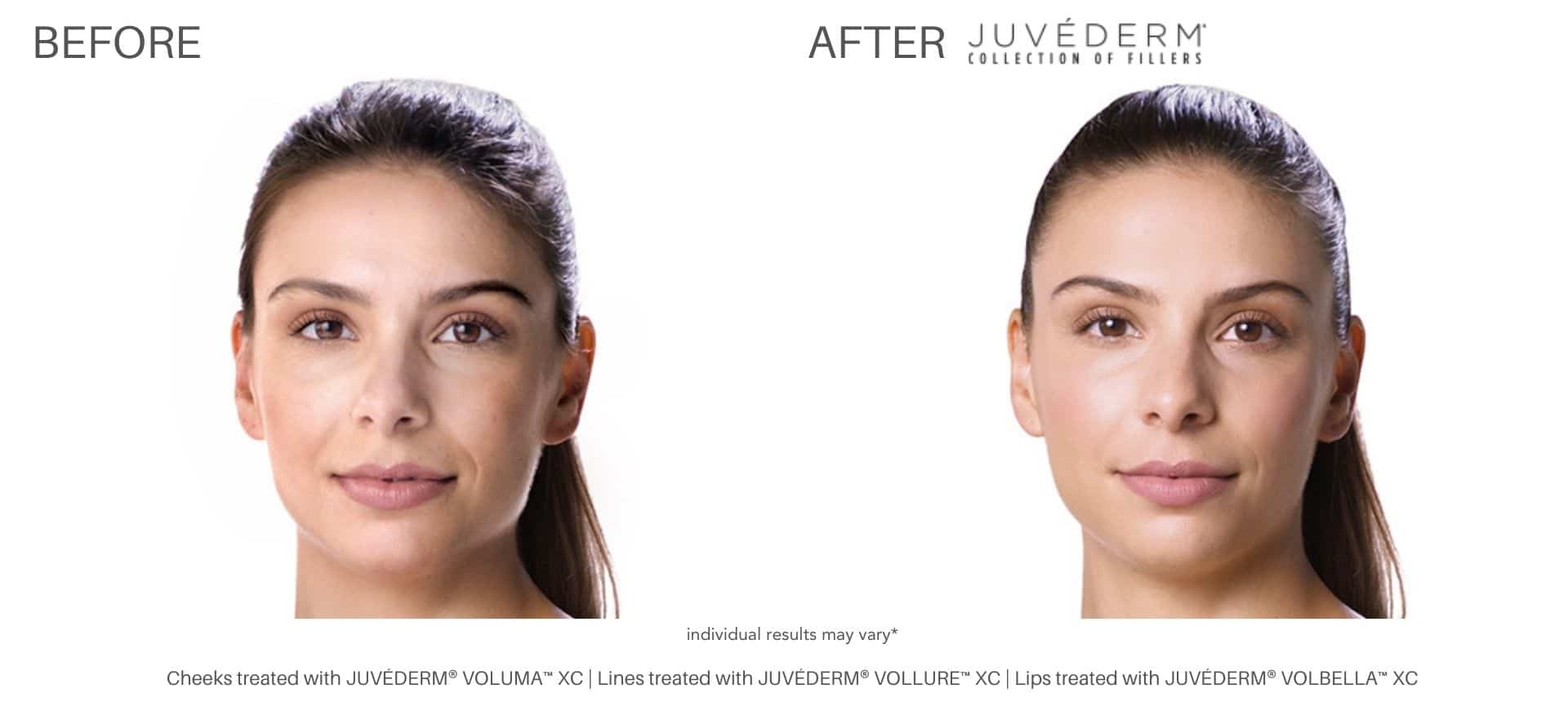 Juvéderm dermal filler treatment in Purchase, NY