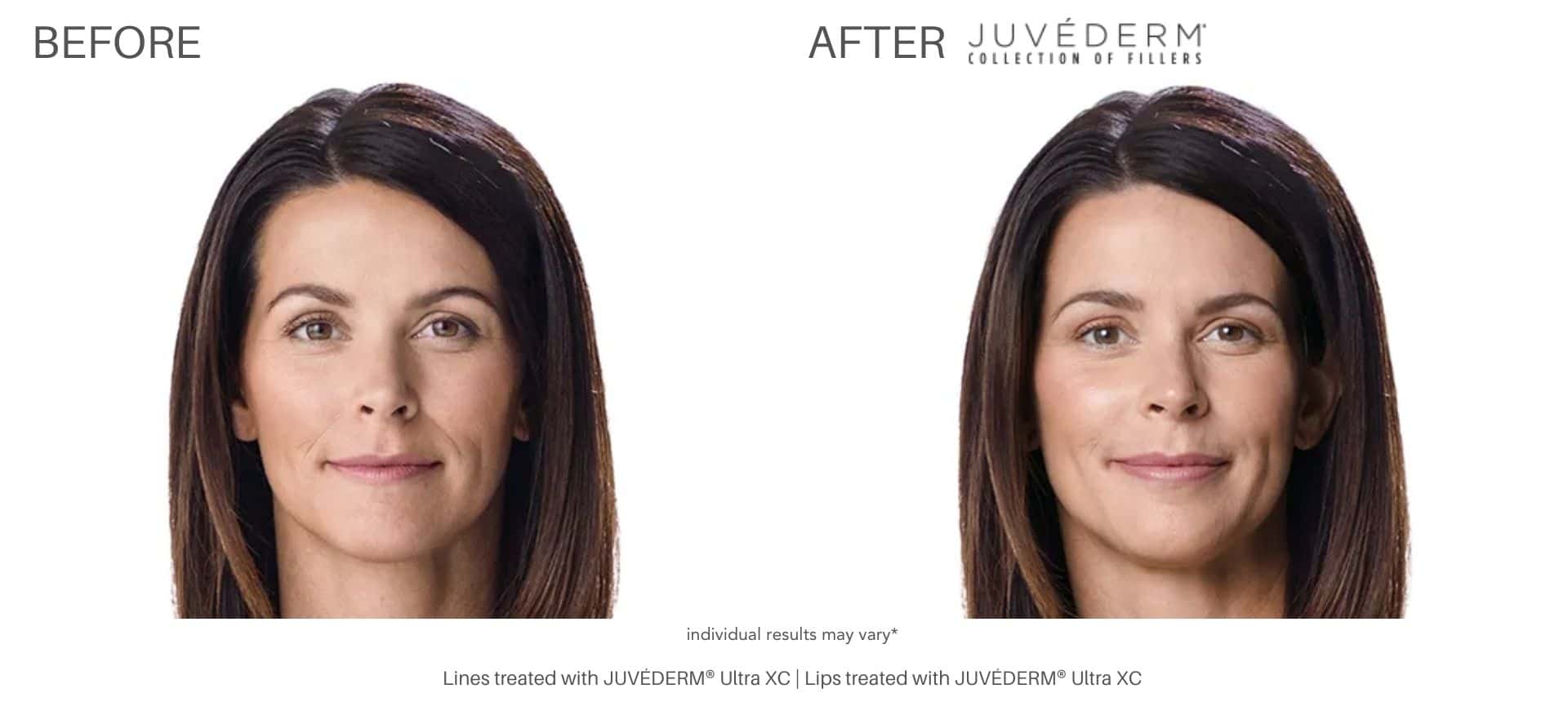 Juvéderm dermal fillers in Purchase, NY