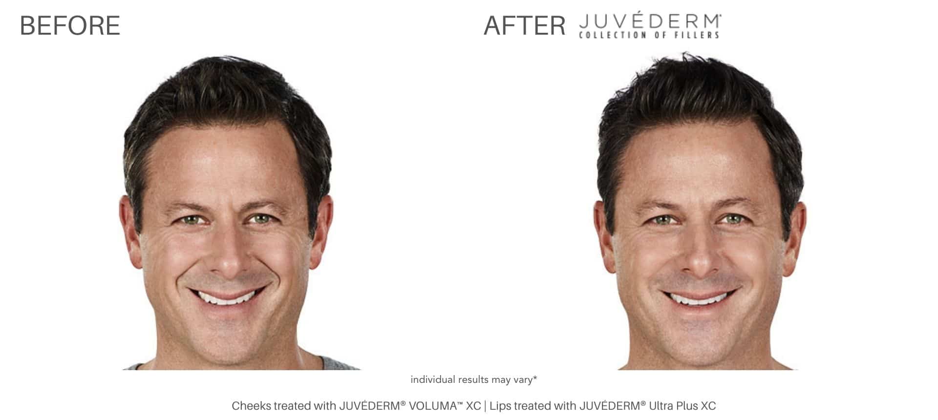 Juvéderm dermal fillers at Advanced Rejuvenation Centers