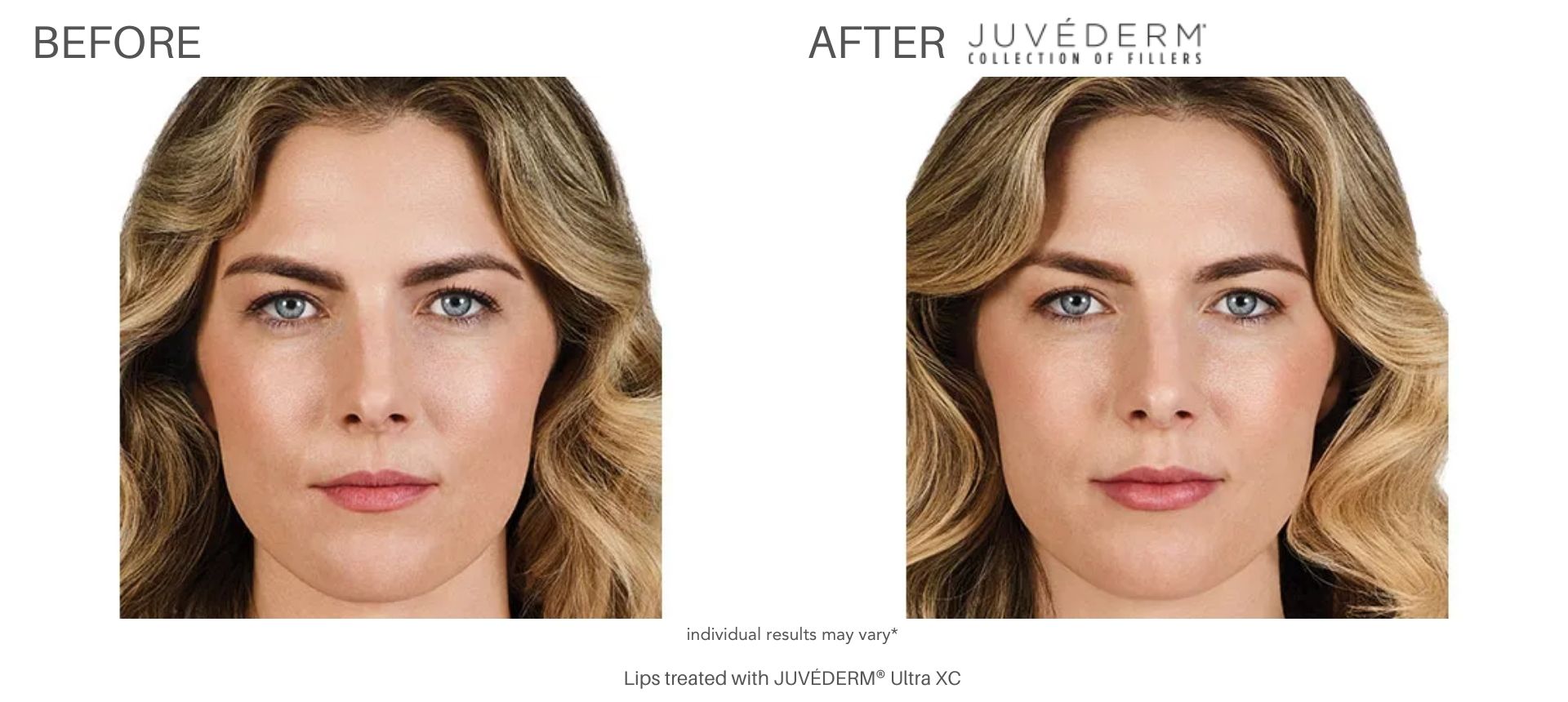 Juvéderm fillers at Advanced Rejuvenation Centers