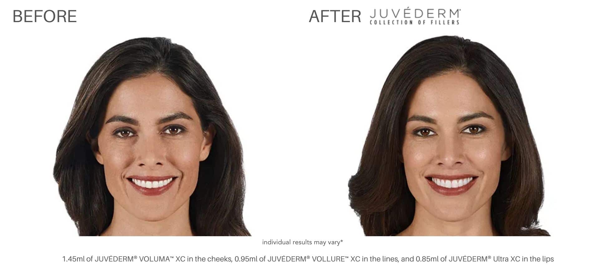 Juvéderm filler treatment at Advanced Rejuvenation Centers