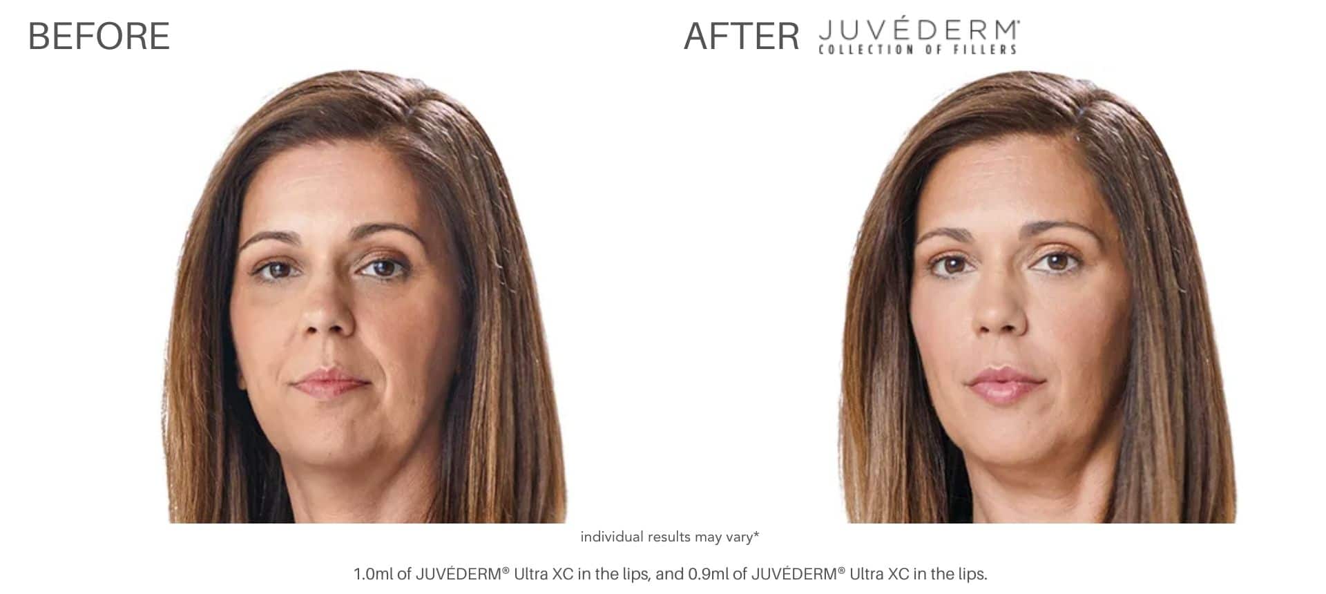 wrinkles and fine lines treatment at Advanced Rejuvenation Centers