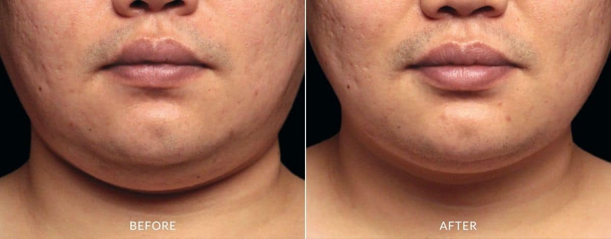 Coolsculpting Chin Reduce Double Chins And Neck Fat